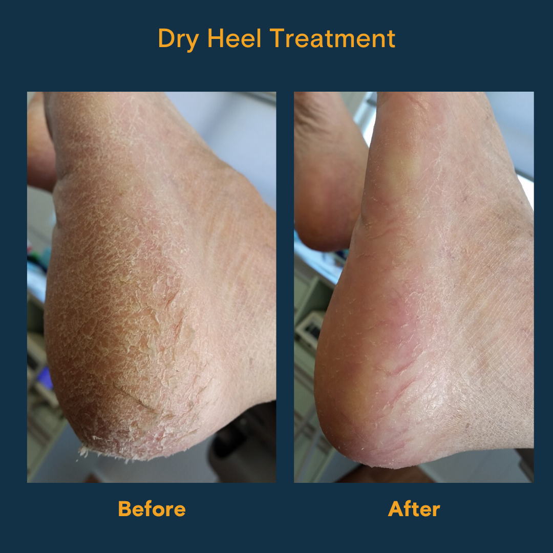 How to manage your feet in winter Blog Dan Everson Podiatry